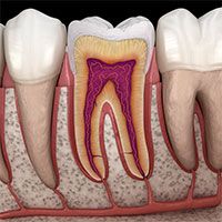 Root Canal Infections